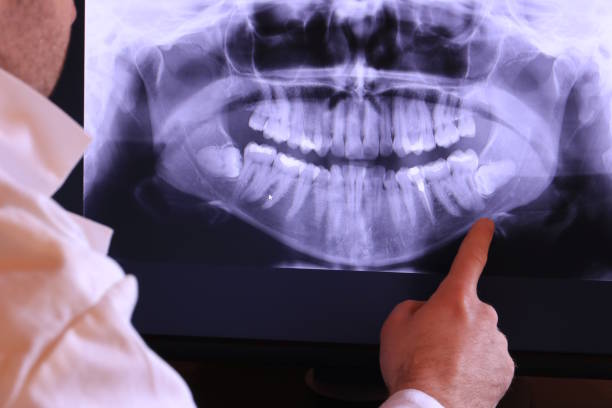 Best Emergency Wisdom Tooth Extraction in Violet, LA