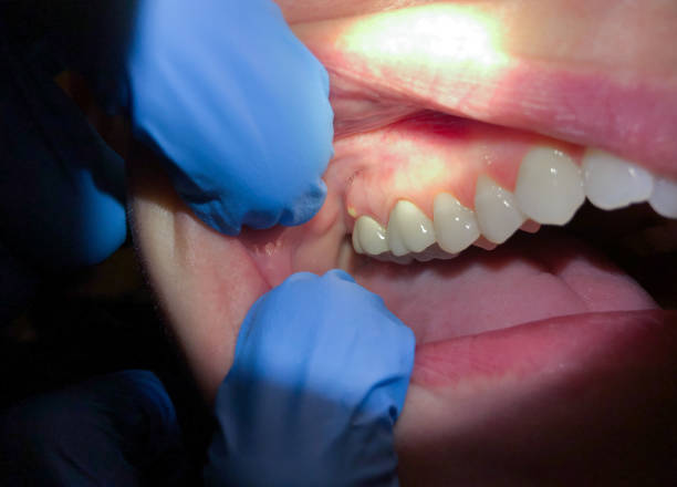 Best Emergency Wisdom Tooth Extraction in Violet, LA