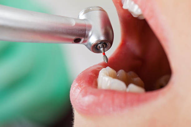 Best Knocked-Out Tooth (Avulsed Tooth) Treatment in Violet, LA